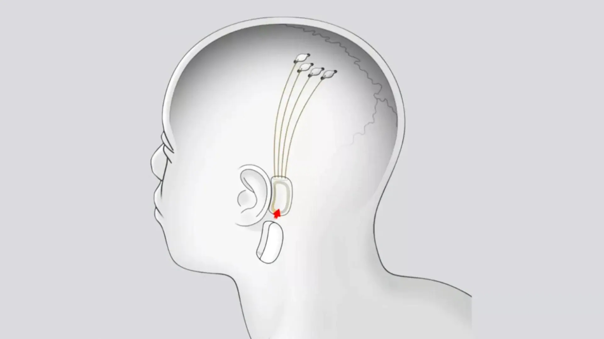 La Neuralink Elon Musk trasmetterà la musica direttamente al cervello attraverso dei chip